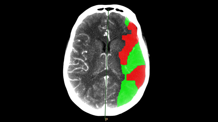 brain perfusion thumbnail