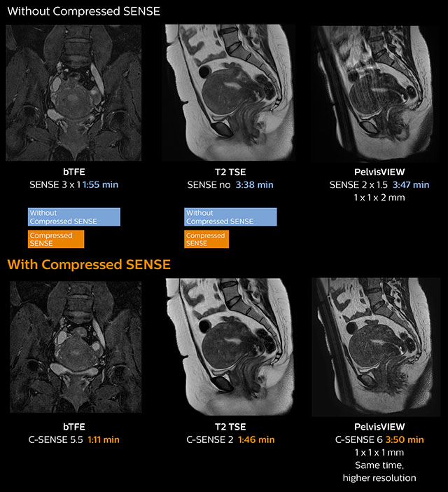 clinical image pelvis myoma compressed sense desktop