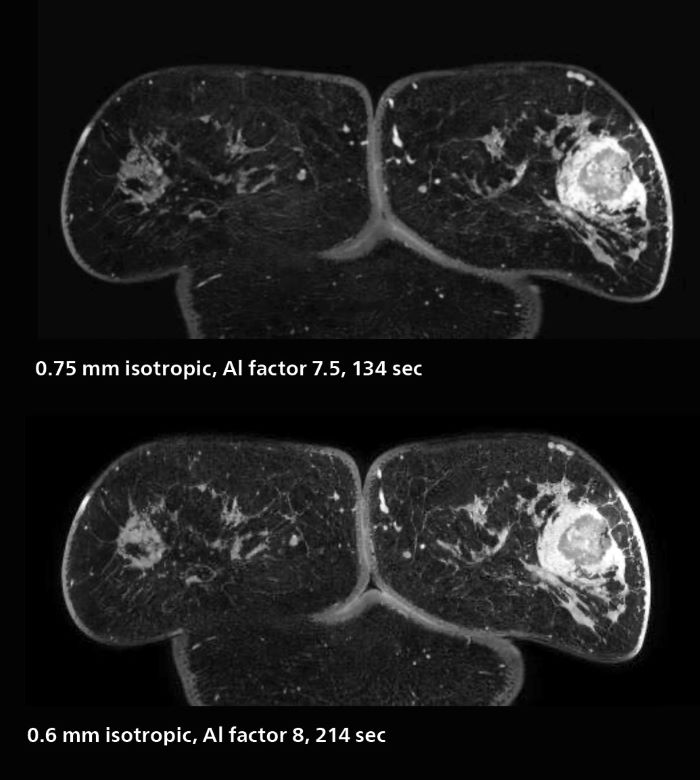 Fast AI-enabled MRI of breast cancer: comparing 3D acquisitions with 0.75 mm and 0.6 mm isotropic voxels, mobile one