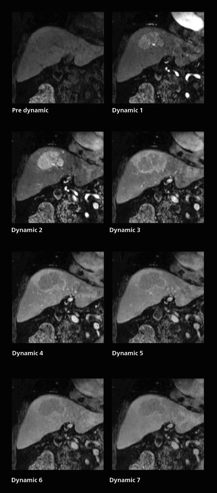Fast dynamic liver MRI: volume dynamic study of 1.05 min, 1.6 x 1.8 x 2.0 mm, 200 slices, mobile