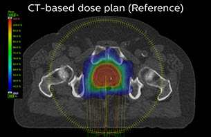 Turku CT based dose plan as reference case 8