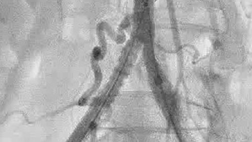 vascular stentboost2 desktop