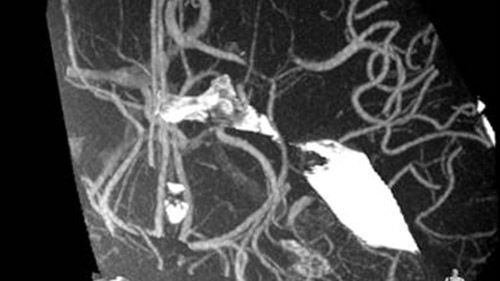 Advanced Stroke suite L M