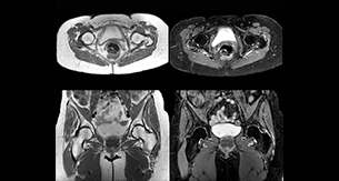 Lefebvre Case3 Hip MRI thmb
