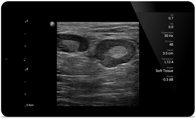 Get the clarity of larger ultrasound systems with Lumify